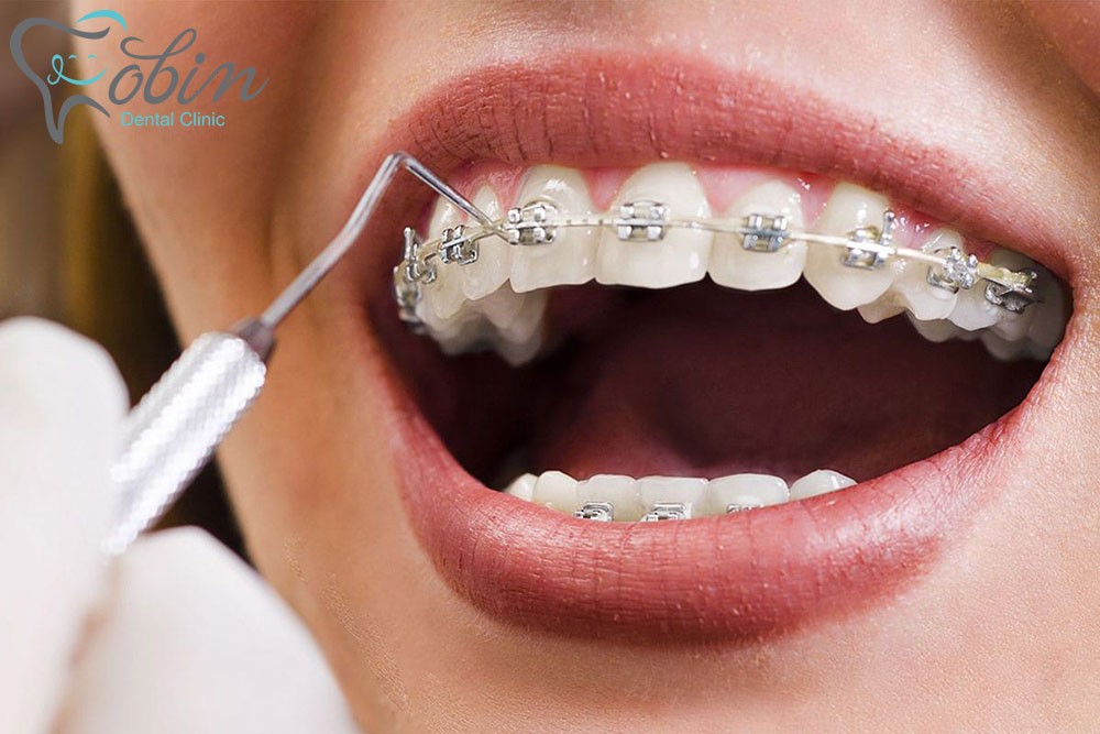 اصلاح دندان با انجام ارتودنسی دندان